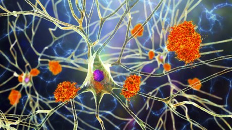 «Հրաշք բույսը». Ալցհեյմերի բուժման նոր բանալի