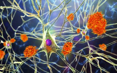 «Հրաշք բույսը». Ալցհեյմերի բուժման նոր բանալի